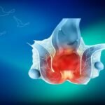 Anal Fissür Tedavisi İstanbul