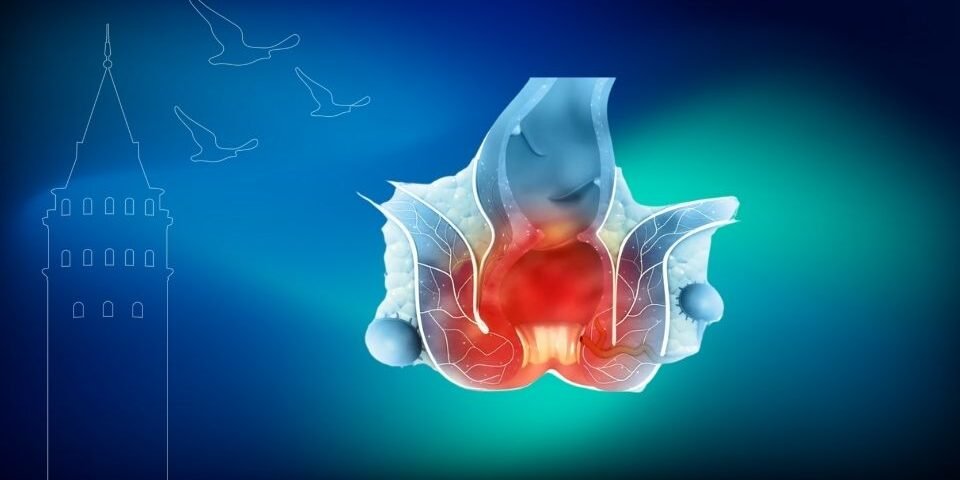 Anal Fissür Tedavisi İstanbul