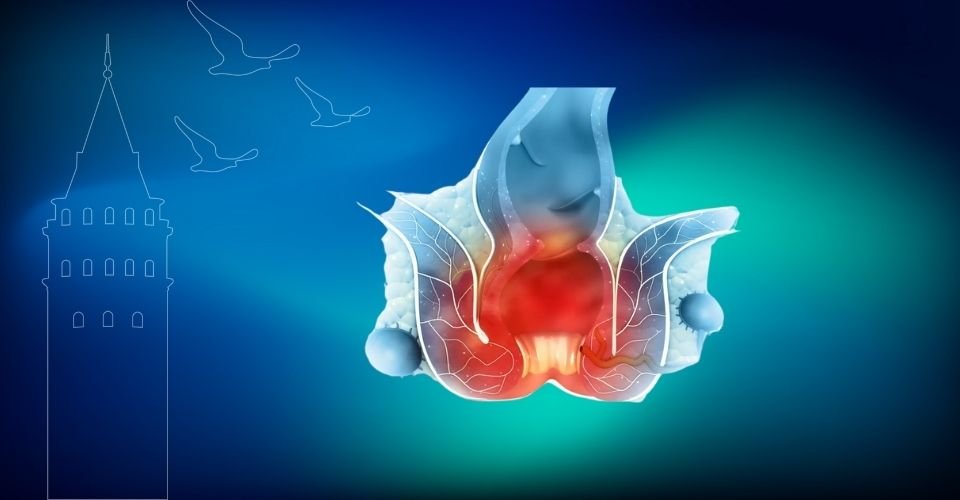 Anal Fissür Tedavisi İstanbul